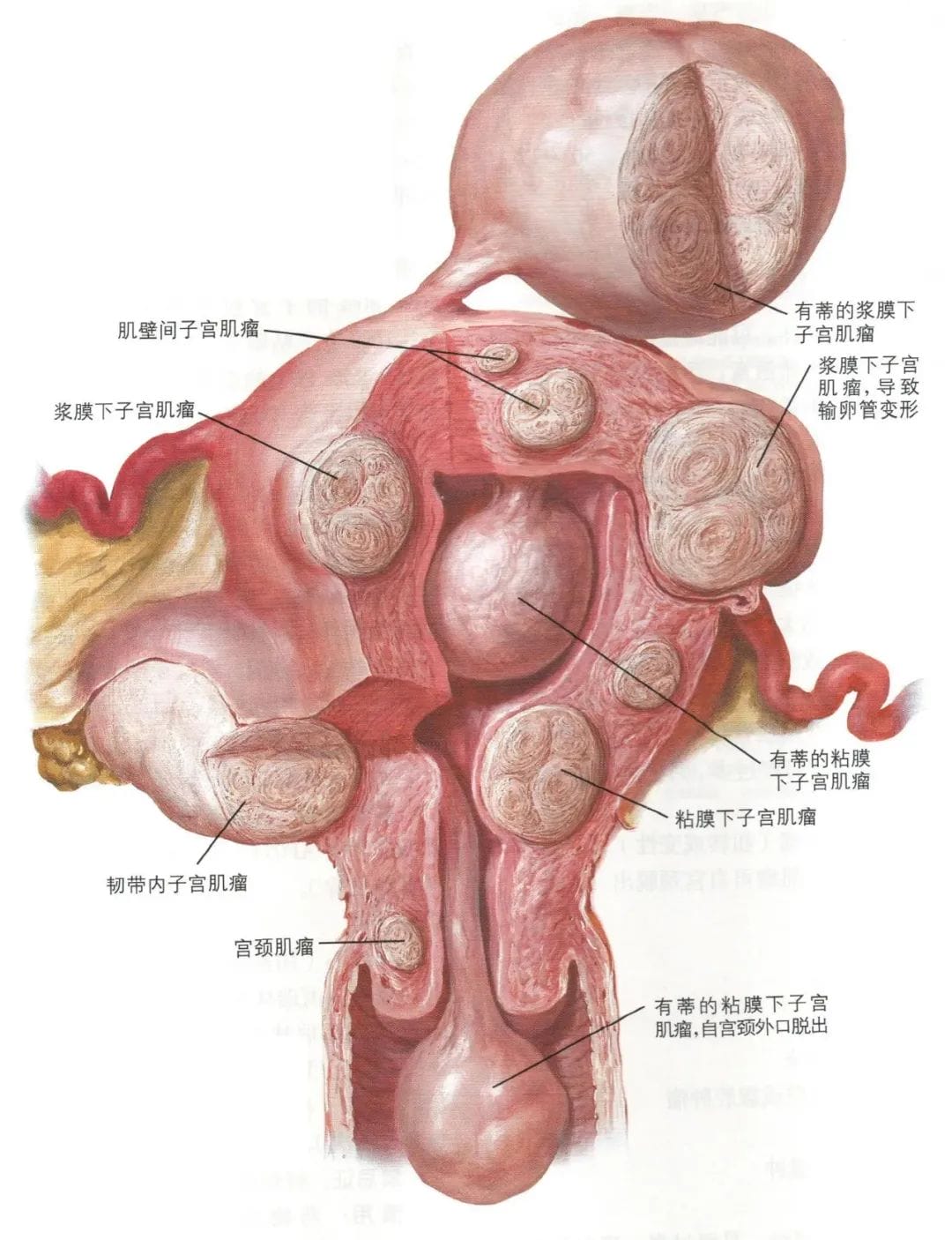 当试管碰上子宫肌瘤，「切」还是「不切」?