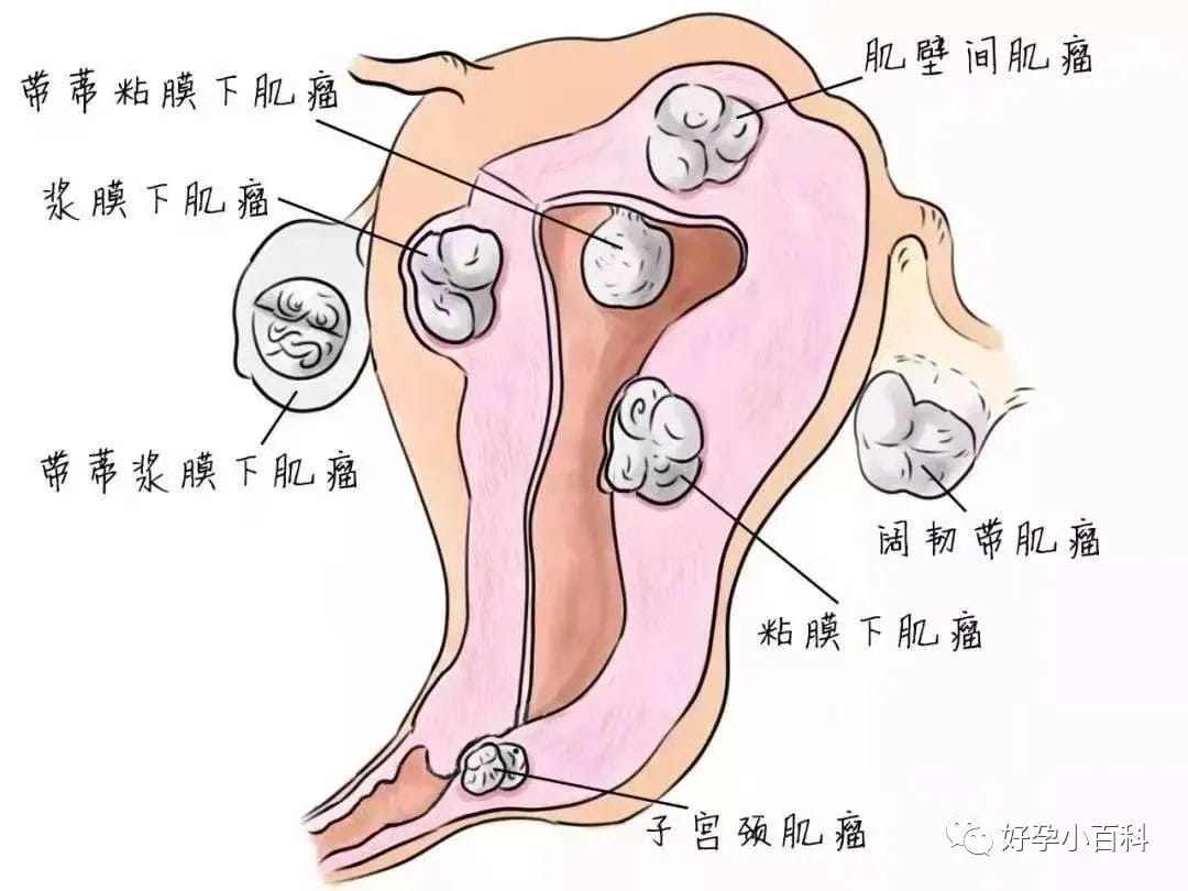 子宫一亩三分地，那遍地的子宫肌瘤！