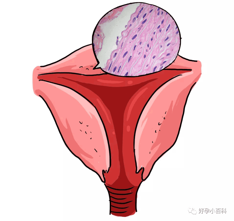 子宫一亩三分地，那遍地的子宫肌瘤！