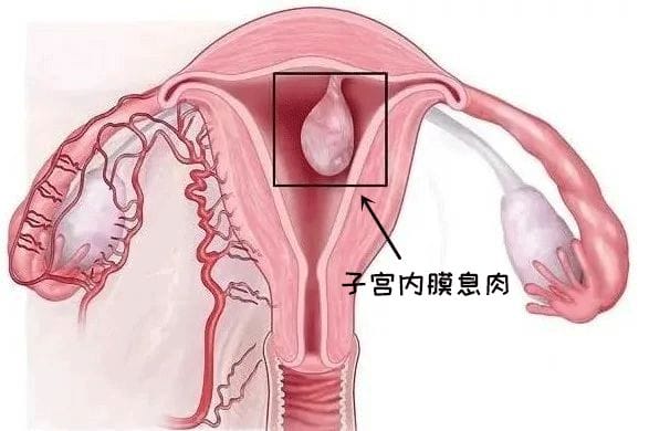 做试管遇见“子宫内膜息肉”，切还是不切？会影响成功率吗？