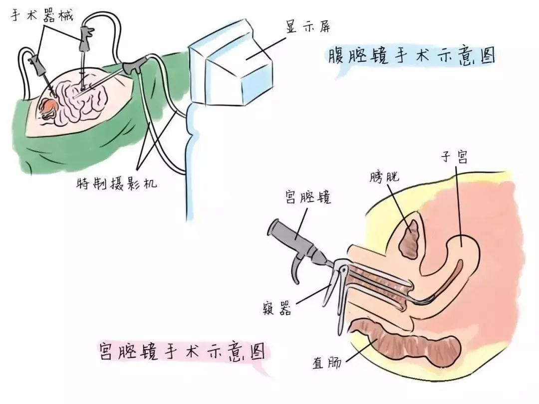 做试管遇见“子宫内膜息肉”，切还是不切？会影响成功率吗？