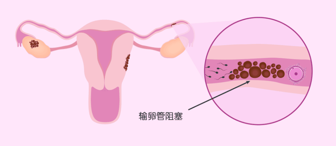 备孕 | 输卵管堵塞好孕秘籍