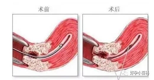 孕育课堂 | 如何预防备孕路上的7种免疫性不孕症？