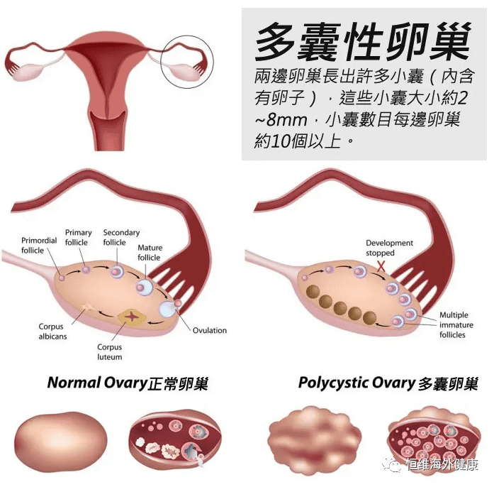 多囊=不孕？别慌！这样做也能快速迎好「孕」