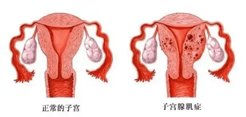 痛经越来越严重，那你要小心“它”了！