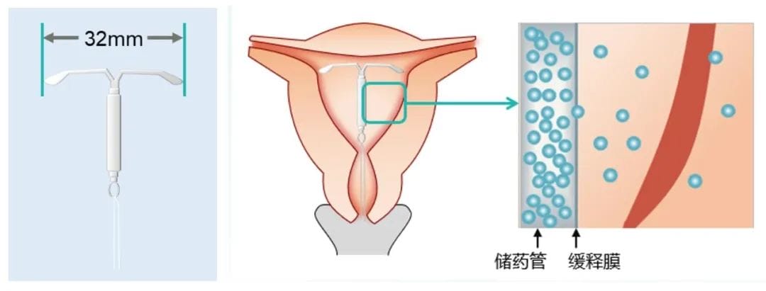 痛经越来越严重，那你要小心“它”了！