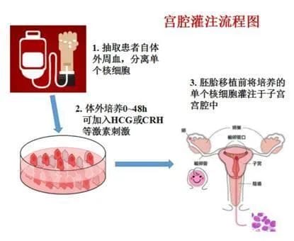 低调的不孕"真凶"——慢性子宫内膜炎！