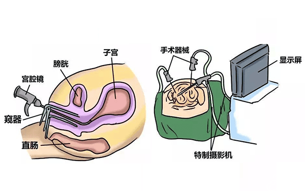 长在宫腔里的“多肉”是备孕之路的“绊脚石”！