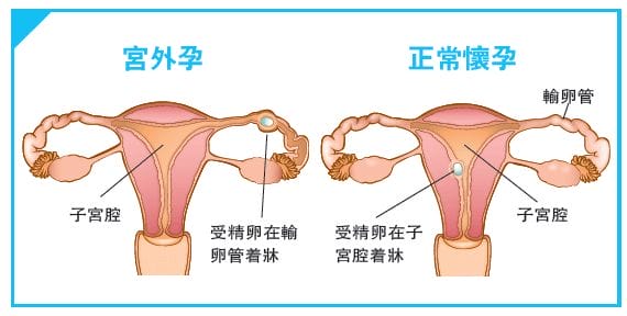 试管知识 | “鹊桥”积水也会影响试管成功率！