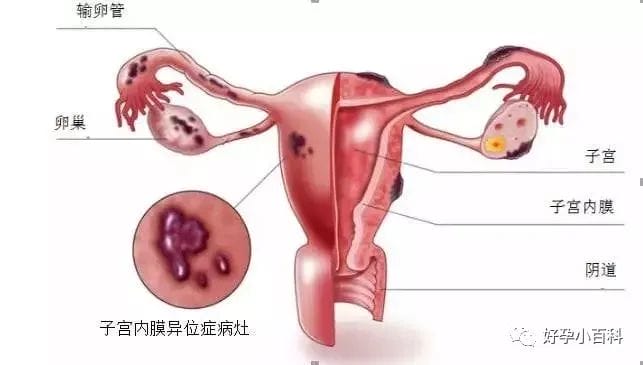 做试管婴儿，医生为什么叫我做宫腔镜?