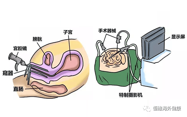 试管前还在纠结宫腔镜?到底是「做」还是「不做」