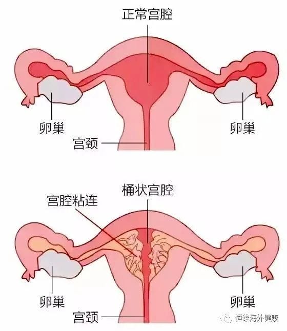 试管前还在纠结宫腔镜?到底是「做」还是「不做」