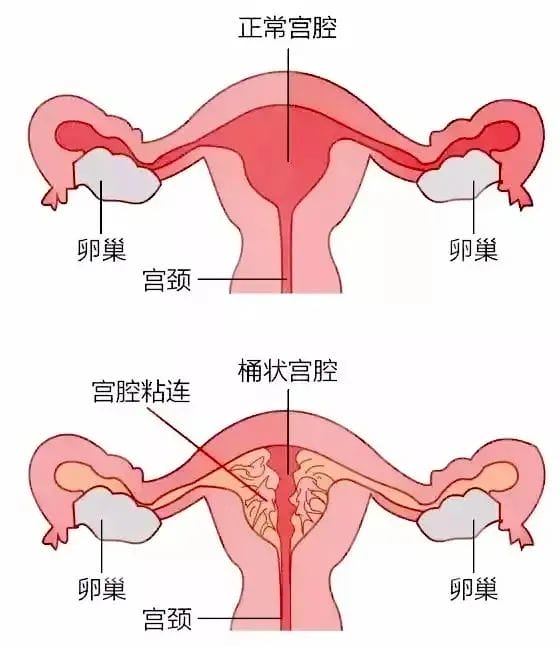 宫腔镜到底是「做」还是「不做」?