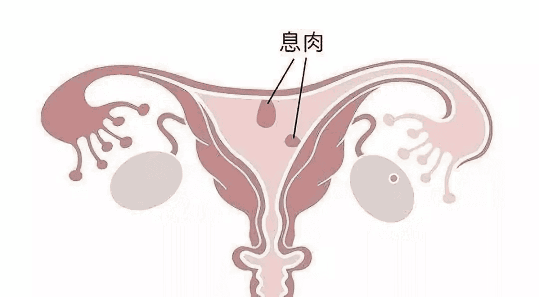 宫腔镜到底是「做」还是「不做」?