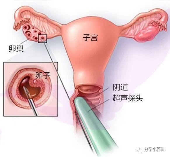 盘点试管促排的那些事儿！