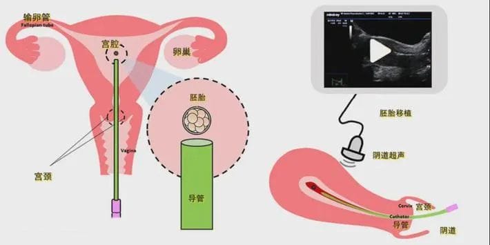 试管知识 | 胚胎质量好坏的“秘密”！