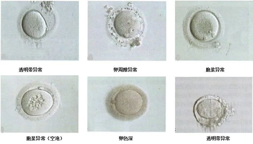 试管婴儿「一击即中」​的秘诀——胚胎质量！