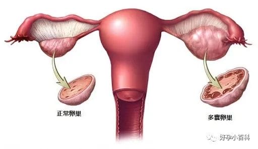 试管促排卵的梦魇——卵巢过度刺激综合征！