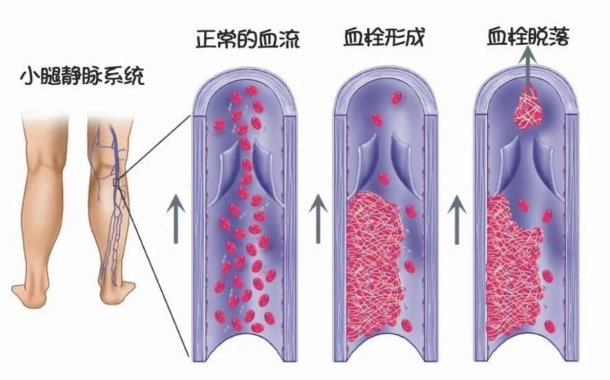 取卵越多越好?小心卵巢过度刺激综合征！