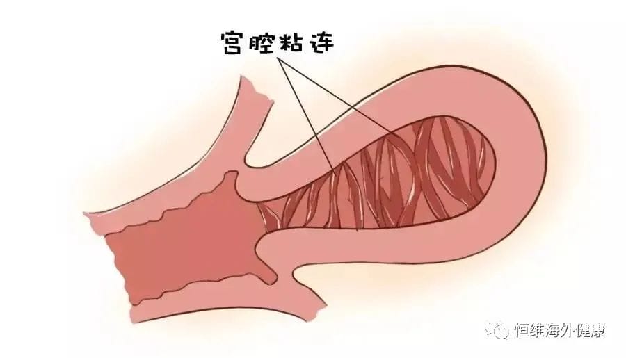 导致胎停流产的6个因素，孕早期该如何预防避免?