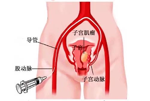 出现胎心胎芽还会胎停？三代试管来帮忙！