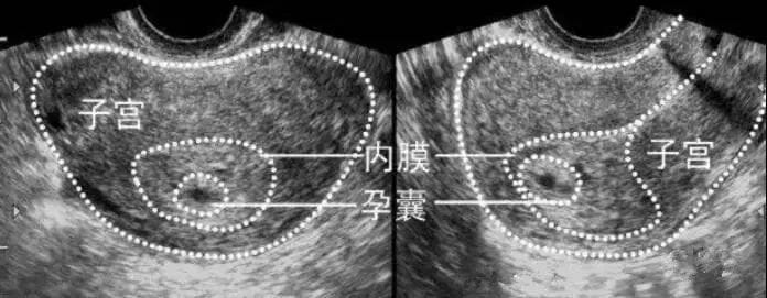 验到两条杠，最后却查出怀了个空孕囊？！