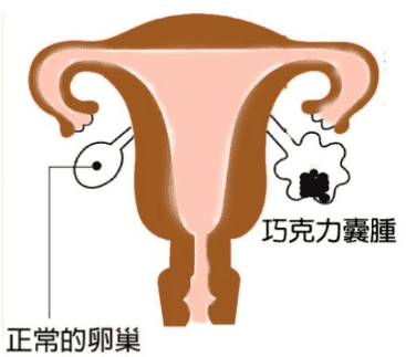 卵巢“巧克力囊肿”合并不孕，做手术还是试管?