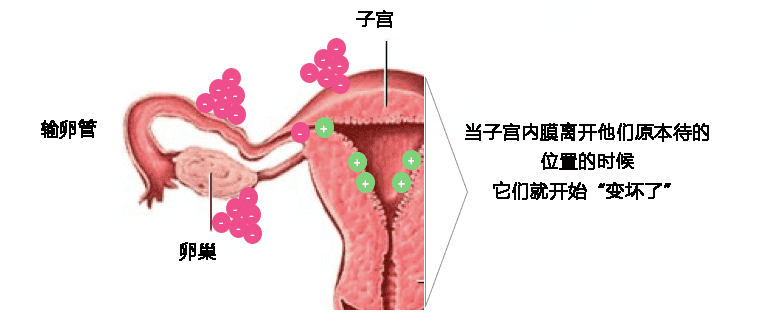 卵巢“巧克力囊肿”合并不孕，做手术还是试管?