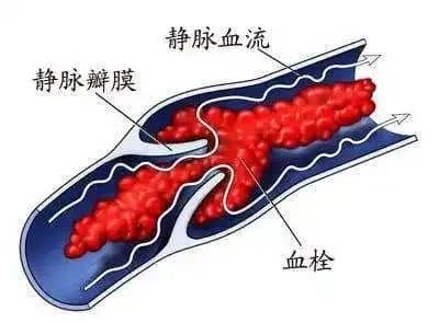 低分子肝素真的只是保胎神药？你要的真相来了