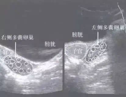 雄激素过高危害大，备孕女性要注意！