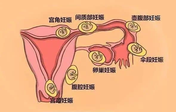 孕早期出血急着保胎？这3种情况值得警惕！