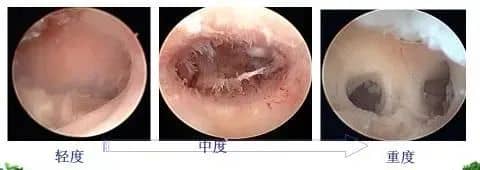 备孕人群必看！宫腔粘连的5个信号