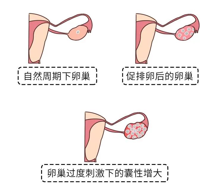 规避试管并发症的4条建议，八成姐妹都不知道！