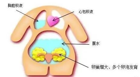 如何降低卵巢过度刺激综合的发生？