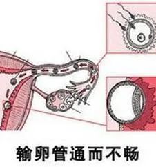 想知道输卵管通不通？检查方法这样选……