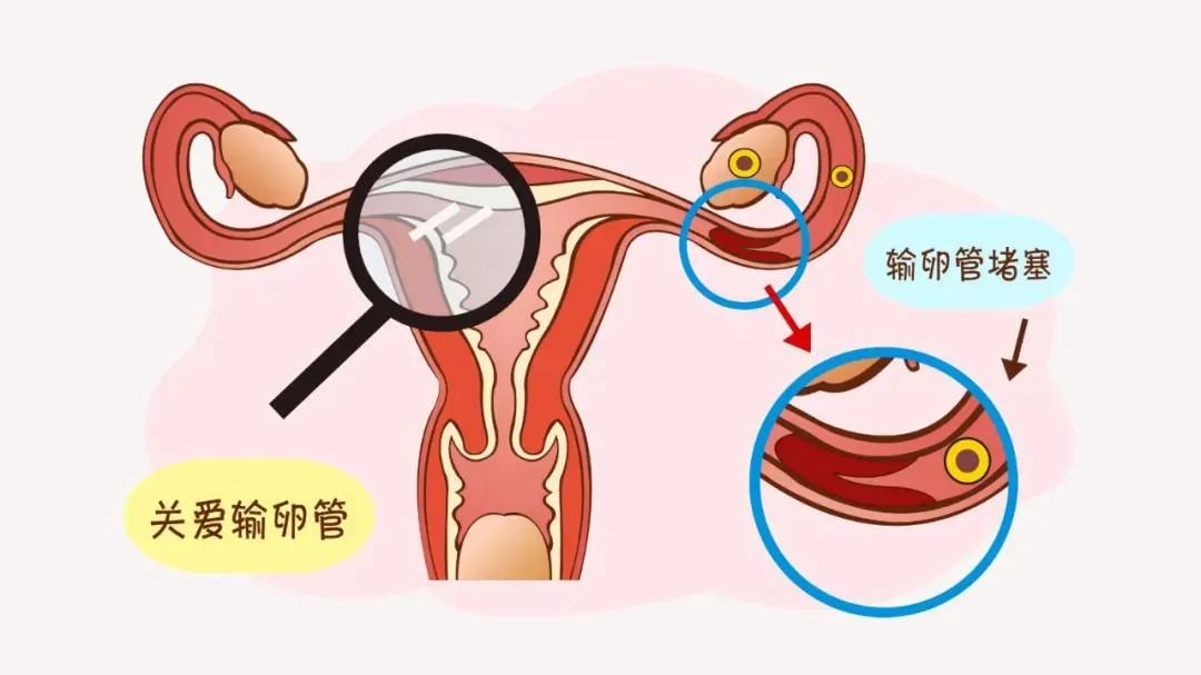 想知道输卵管通不通？检查方法这样选……