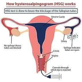 想知道输卵管通不通？检查方法这样选……