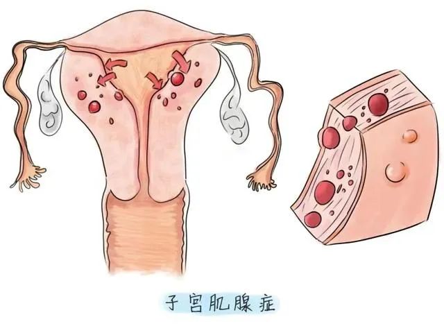 子宫腺肌症合并不孕，该怎么办?