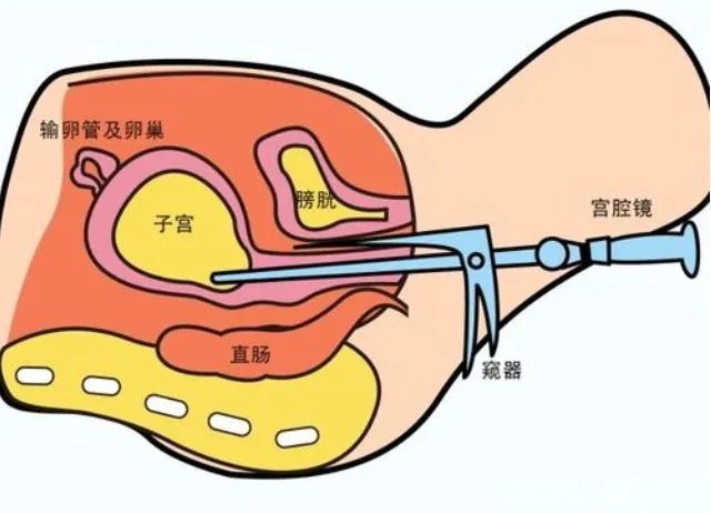 做宫腔镜之前，这些准备功课要做好！