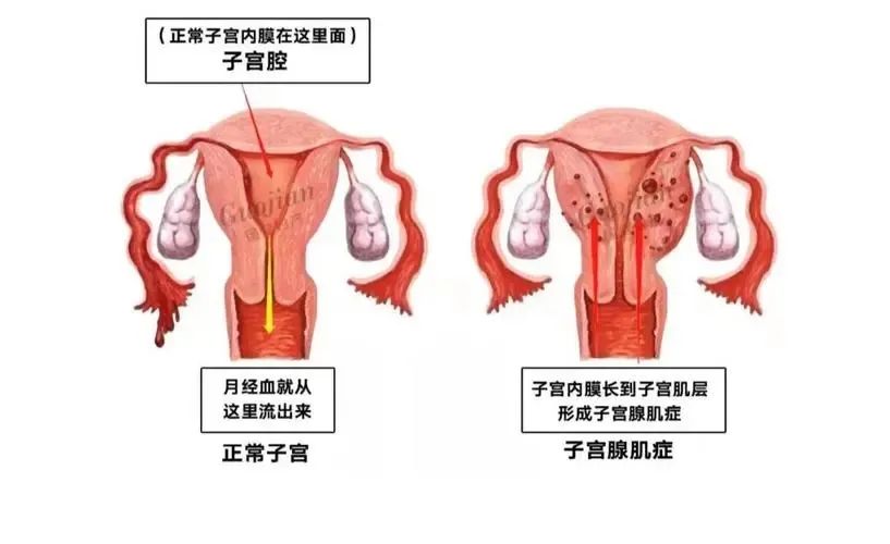 子宫内膜容受性分析对反复移植失败有没有用？