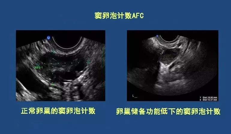 降低FSH就能更快好孕？真的没那么简单