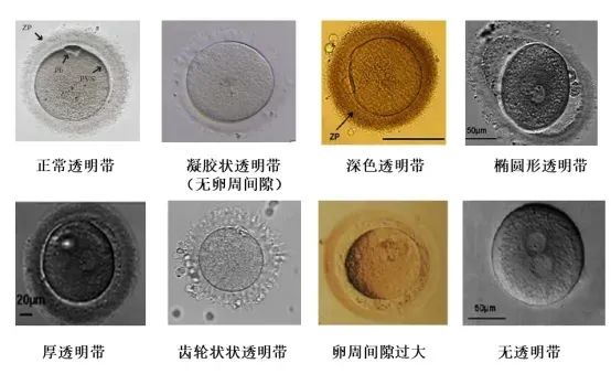 卵母细胞形态学异常对试管有什么影响?