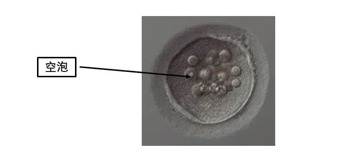 卵母细胞形态学异常对试管有什么影响?