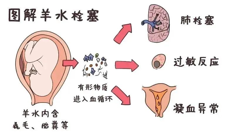 做了试管婴儿，就要剖宫产吗？