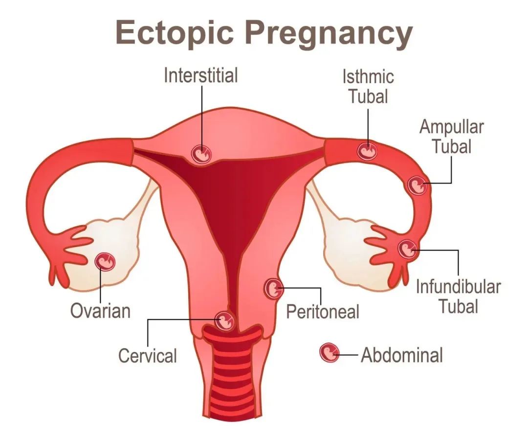 宫外孕是什么？宫外孕还能转回宫内吗？劝你别太离谱！