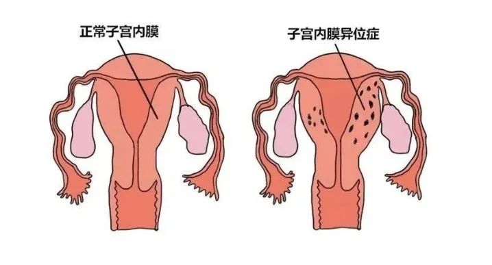 做试管也无法避免胎停，超90%都是因为这个因素！