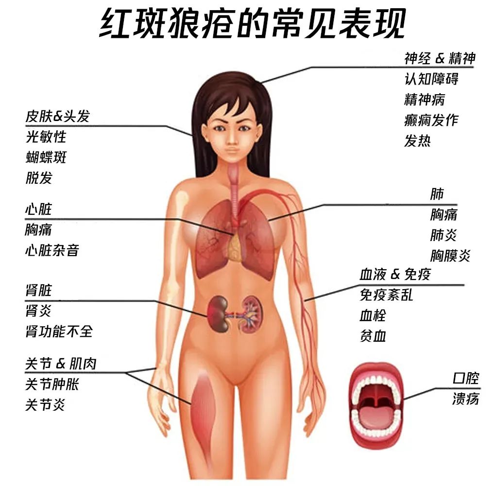 系统性红斑狼疮再惹热议，这一疾病究竟有多严重？