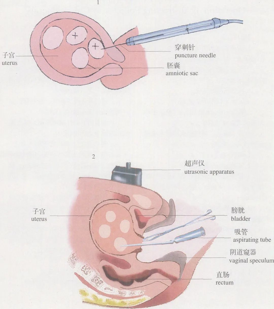 促排后怀上九胞胎，没有惊喜只有惊吓！