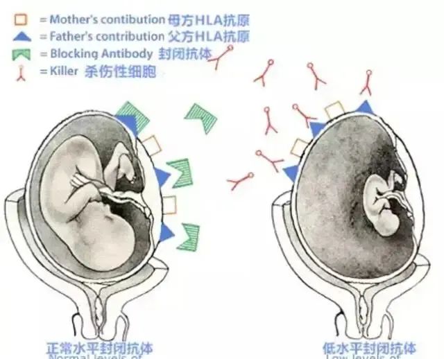 复发性流产？别忘了查封闭抗体！