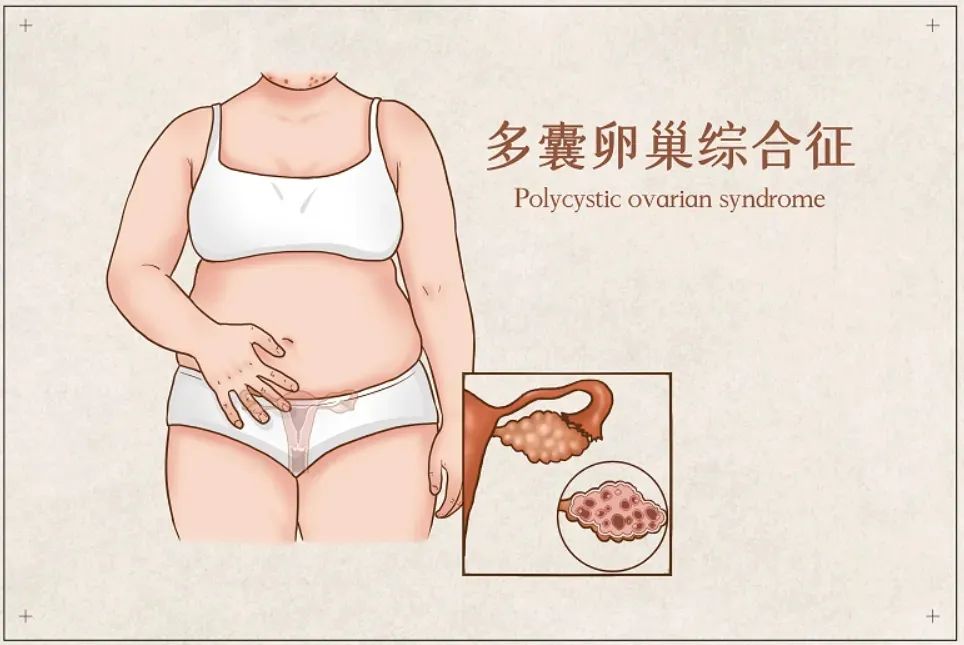 多囊卵差、易流产，都是因为这个关键因素！
